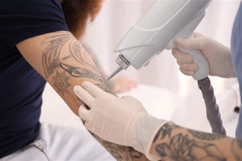 laser tattoo removal wilmington